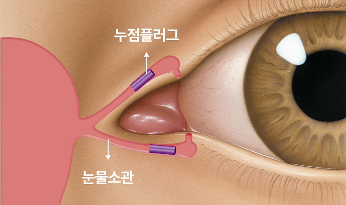 환자 상태에 따른 맞춤형 플러그